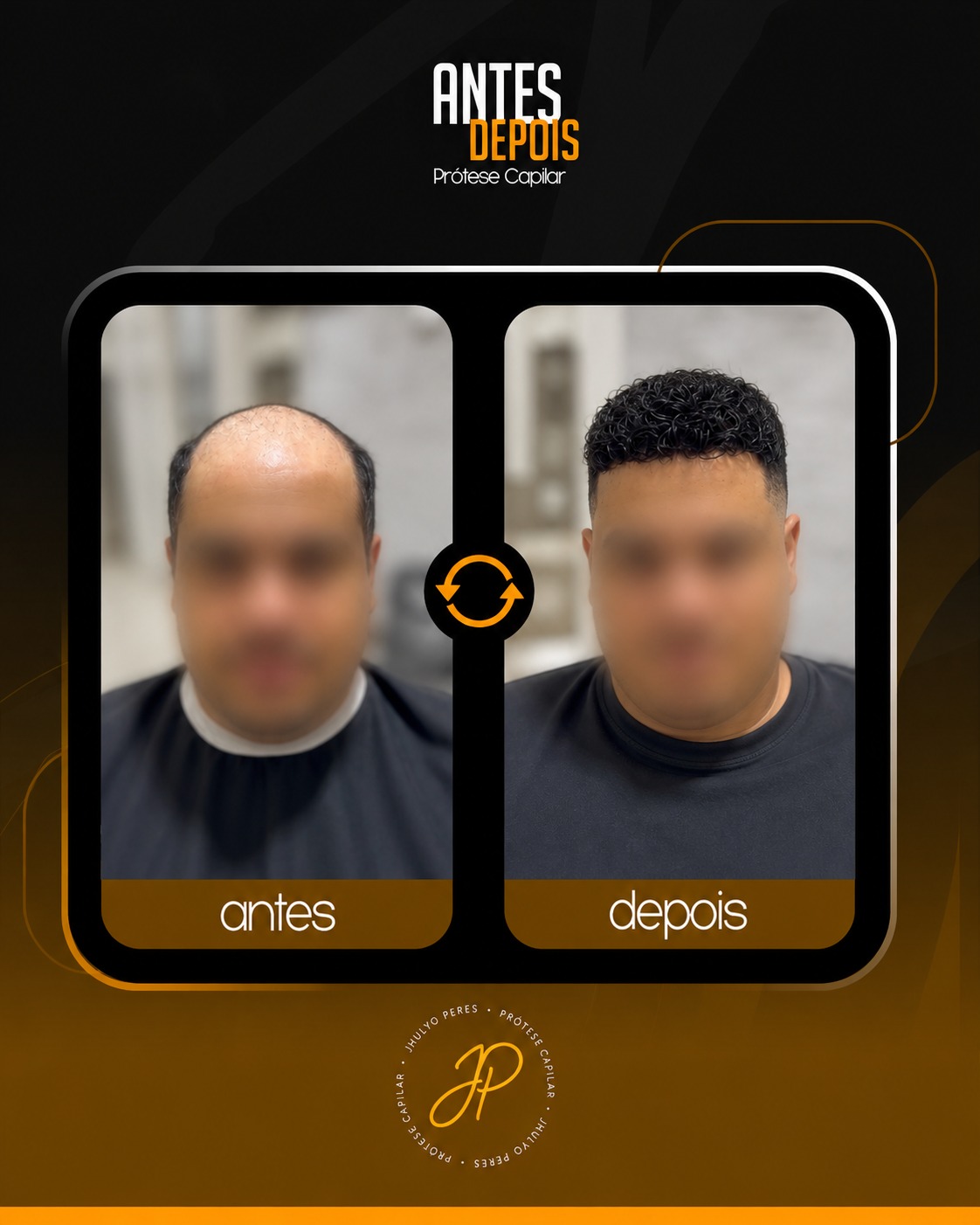 Antes e depois de prótese capilar masculina - resultado real em Araucária-PR