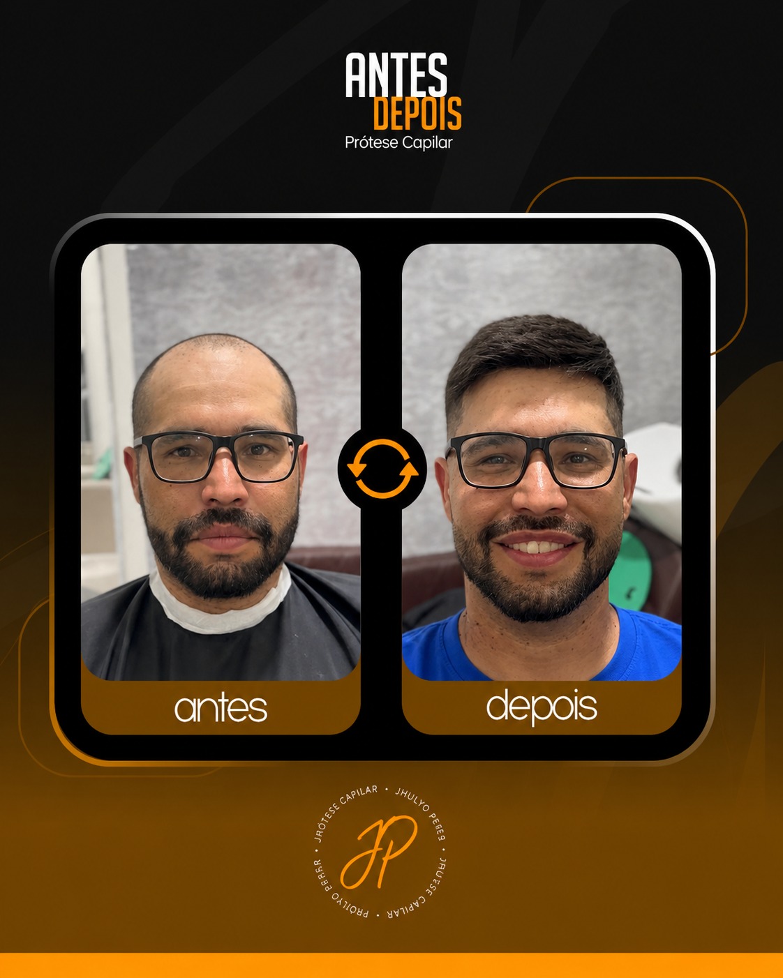 Resultado de prótese capilar Jhulyo Peres - antes e depois natural