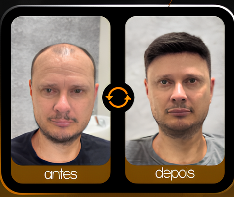 Antes e depois de prótese capilar masculina para calvície avançada