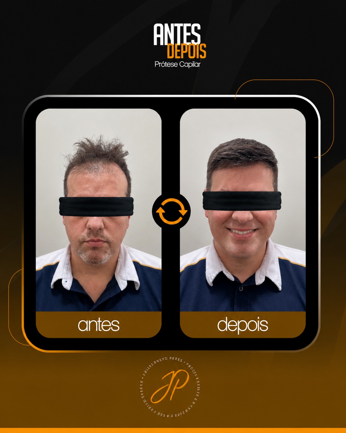 Antes e depois de prótese capilar masculina em Araucária-PR - resultado natural