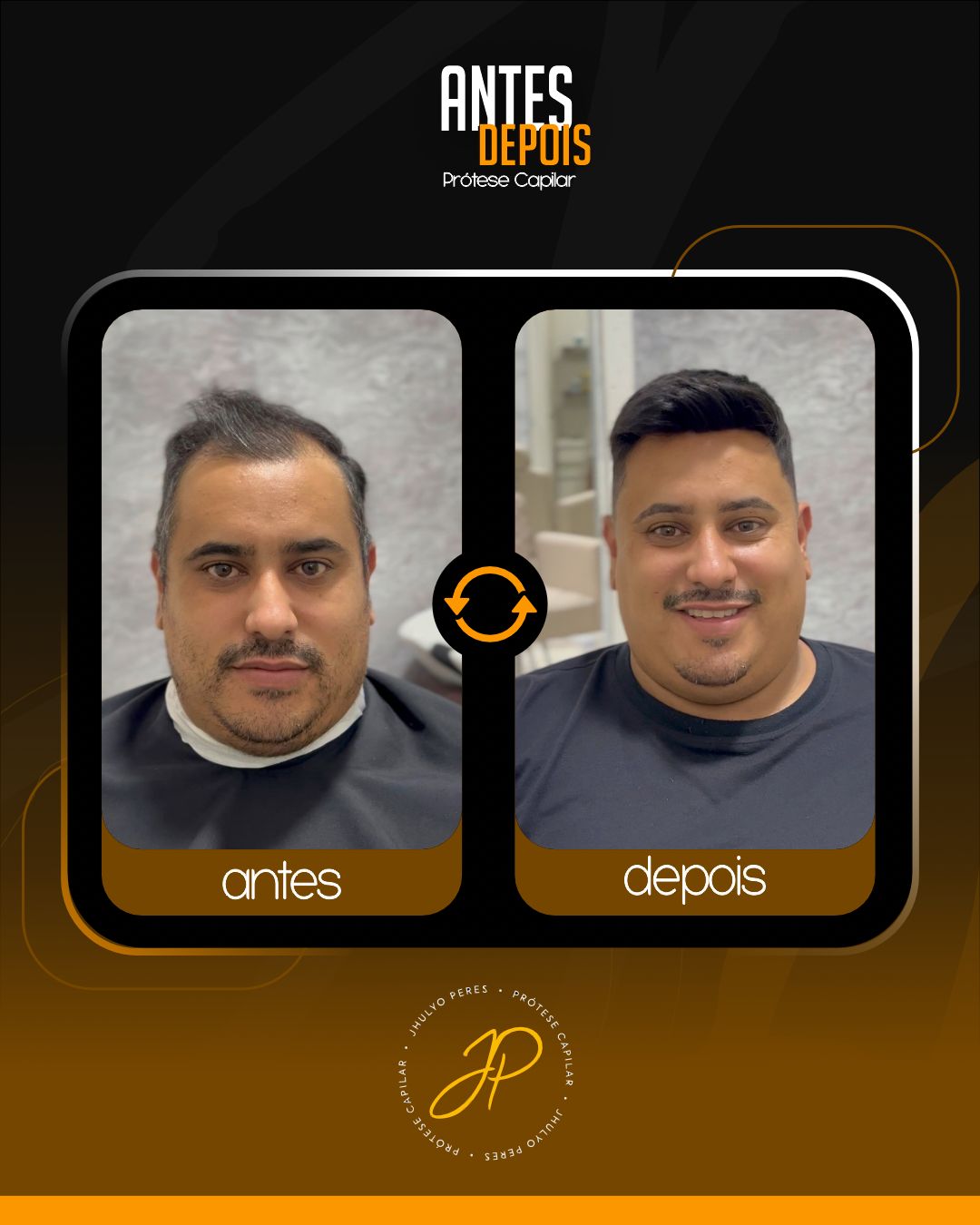 Transformação com prótese capilar - antes e depois em Araucária-PR