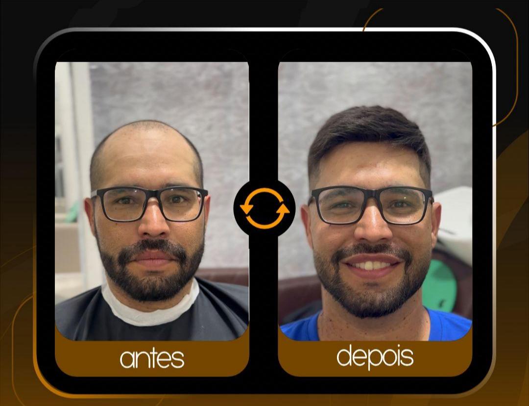 Resultado de prótese capilar masculina - antes e depois real