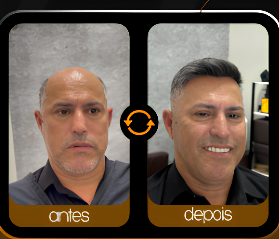 Cliente antes e depois de prótese capilar em Araucária-PR - resultado natural